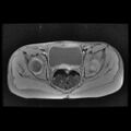 Avascular necrosis of the hip (Radiopaedia 29563-30067 Axial T1 fat sat 4).jpg