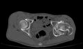 Avascular necrosis of the left hip (Radiopaedia 75068-86125 Axial bone window 48).jpg