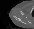 Avulsion fracture - greater tuberosity of humerus (Radiopaedia 71216-81514 Axial bone window 21).jpg