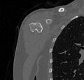 Avulsion fracture - greater tuberosity of humerus (Radiopaedia 71216-81514 Coronal bone window 7).jpg