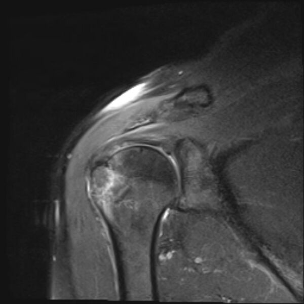 File:Avulsion fracture - greater tuberosity of humerus (Radiopaedia 71216-81515 Coronal PD fat sat 11).jpg