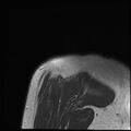 Avulsion fracture - greater tuberosity of humerus (Radiopaedia 71216-81515 Coronal T1 1).jpg