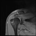 Avulsion fracture - greater tuberosity of humerus (Radiopaedia 71216-81515 Coronal T2 9).jpg