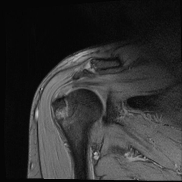File:Avulsion fracture - greater tuberosity of humerus (Radiopaedia 71216-81515 Coronal T2 9).jpg