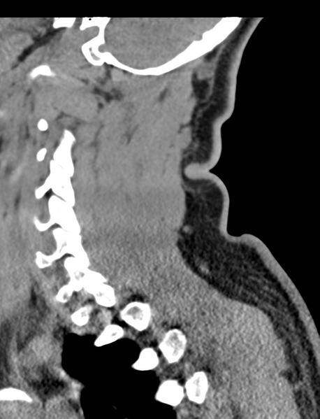 File:Axis peg fracture (type 3) and atlas lateral mass (type 4) fracture (Radiopaedia 37474-39324 D 55).png