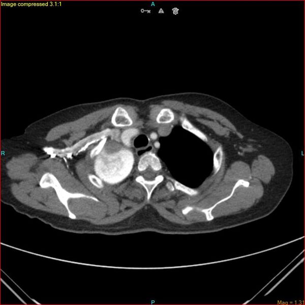 File:Azygos vein aneurysm (Radiopaedia 77824-90130 B 11).jpg