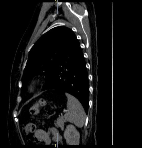 File:Azygos vein aneurysm (Radiopaedia 77824-90130 D 8).JPG