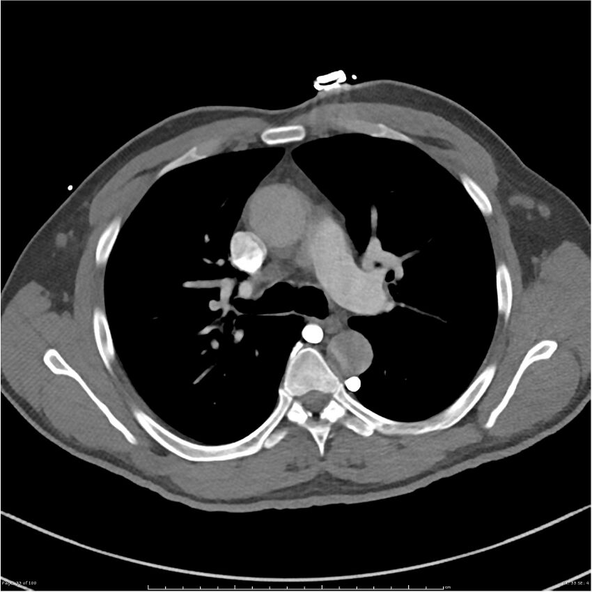 Azygos venous system anatomy (CT pulmonary angiography) (Radiopaedia 25928-26077 Axial C+ CTPA 33).jpg