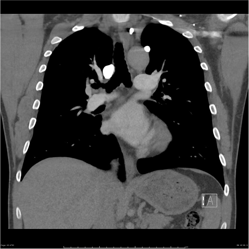 Azygos venous system anatomy (CT pulmonary angiography) (Radiopaedia 25928-26077 Coronal C+ CTPA 41).jpg