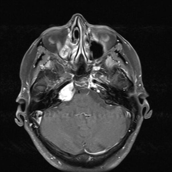 File:Base of skull chondrosarcoma (Radiopaedia 30410-31070 Axial T1 C+ fat sat 10).jpg