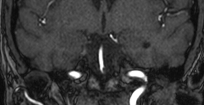 Basilar artery fenestration (Radiopaedia 74537-85455 Coronal MRA TOF 34).jpg