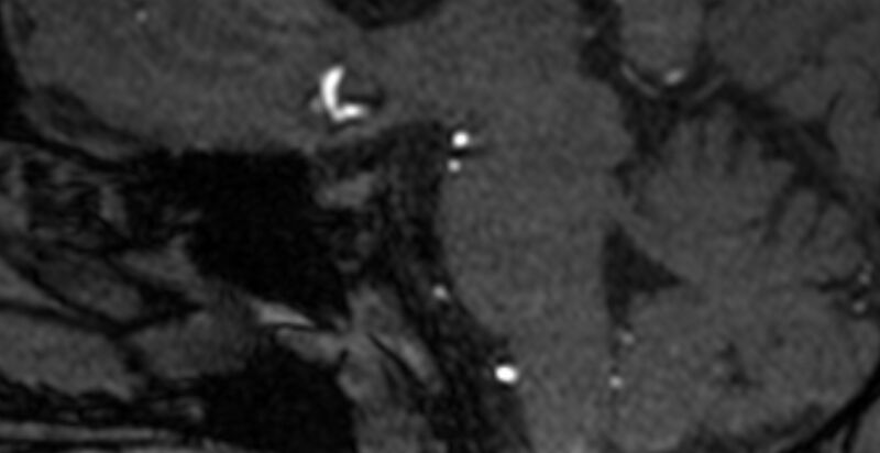File:Basilar artery fenestration (Radiopaedia 74537-85455 Sagittal MRA TOF 9).jpg