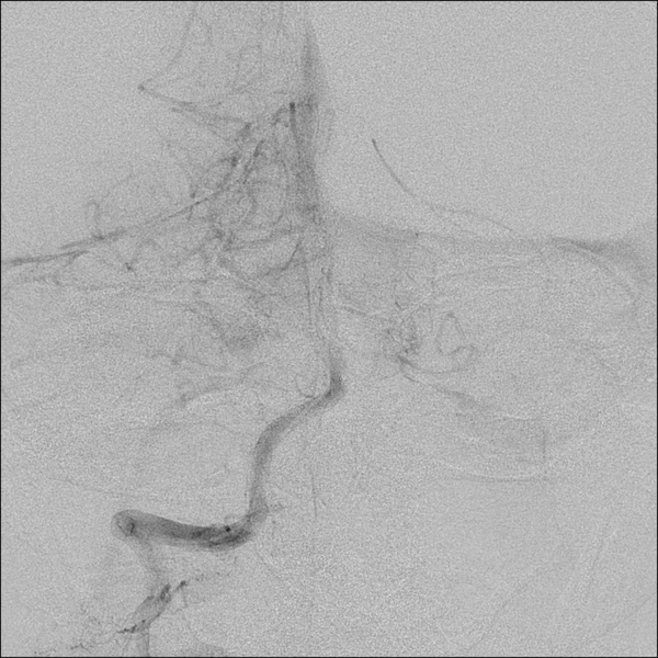 File:Basilar artery thrombosis treated with intra-arterial urokinase (Radiopaedia 34571-35949 B 21).png