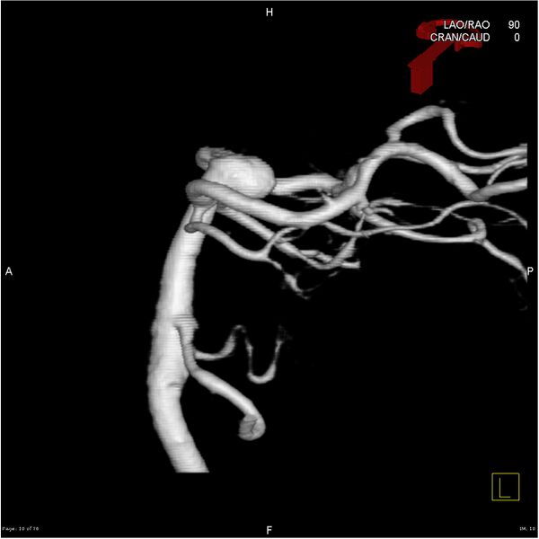 File:Basilar tip aneurysm double balloon remodeling (Radiopaedia 18100-17883 3D rotation 10).jpg