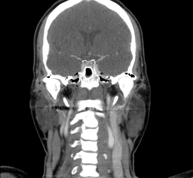 File:Benign mixed salivary tumor of the parotid gland (Radiopaedia 35261-36792 B 17).jpg