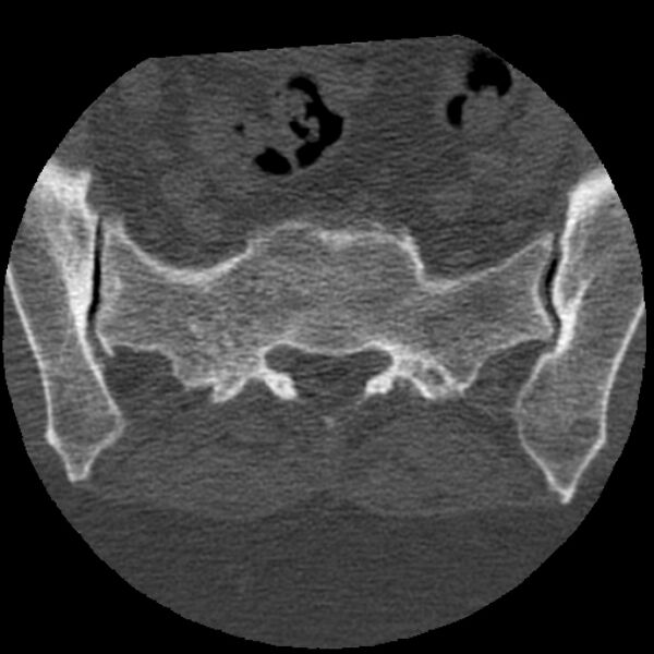 File:Bertolotti syndrome (Radiopaedia 24864-25128 Axial bone window 39).jpg