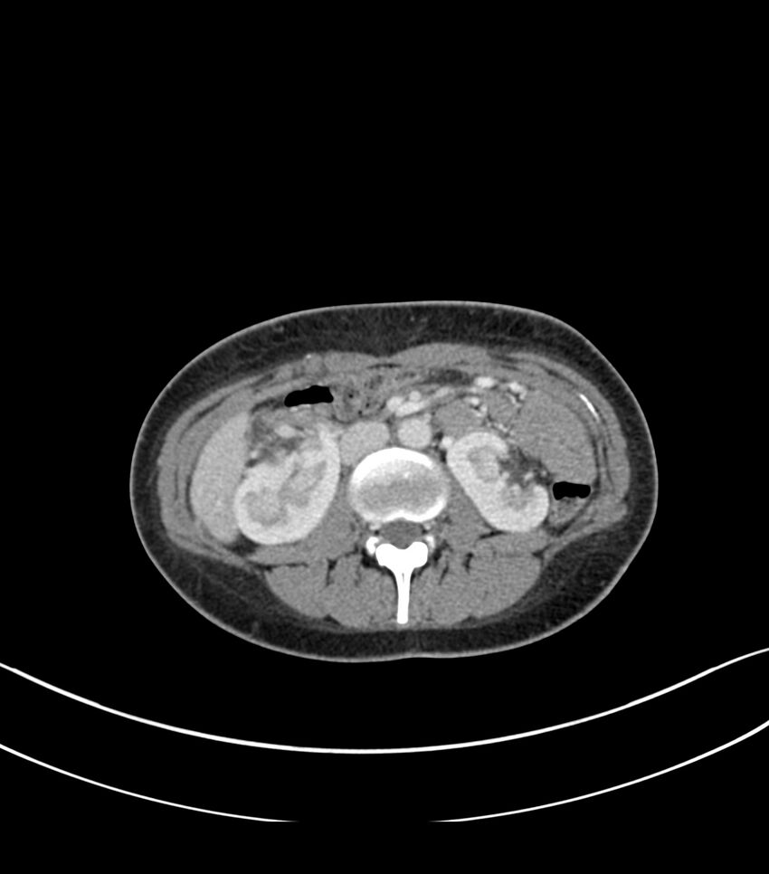 Bilateral kidney malrotation (Radiopaedia 72227-82749 A 24).jpg
