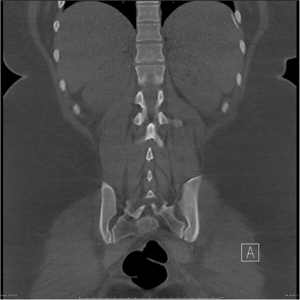 File:Bilateral lumbar ribs (Radiopaedia 25862-26010 Coronal bone window 16).jpg