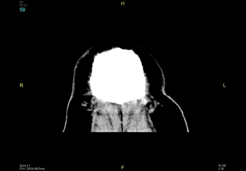 Bilateral medial medullary infarction (Radiopaedia 42220-45295 Coronal non-contrast 59).jpg