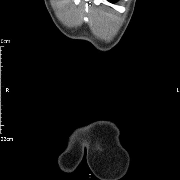 File:Bilateral medullary nephrocalcinosis with ureteric calculi (Radiopaedia 71269-81569 Coronal non-contrast 76).jpg