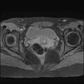 Bilateral ovarian endometriomas (Radiopaedia 87085-103347 Axial T1 fat sat 15).jpg