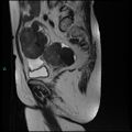 Bilateral ovarian fibroma (Radiopaedia 44568-48293 Sagittal T2 12).jpg