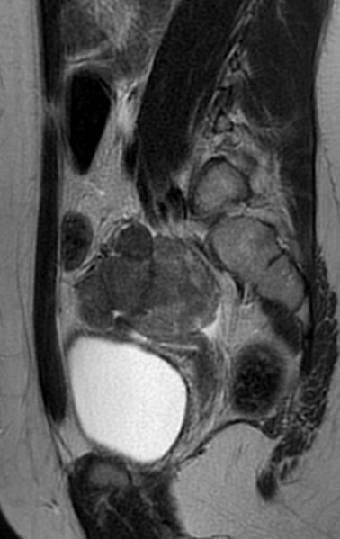 File:Bilateral ovarian fibrothecomas - adolescent (Radiopaedia 86604-102707 Sagittal T2 23).jpg