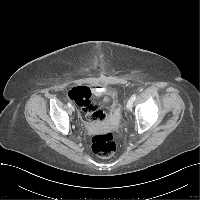 Bilateral psoas hematomas (Radiopaedia 24057-24279 A 77).jpg