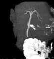 Bile leak from accessory duct(s) of Luschka post cholecystectomy (Radiopaedia 40736-43389 D 19).jpg