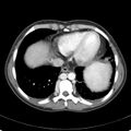 Biliary necrosis - liver transplant (Radiopaedia 21876-21846 B 5).jpg