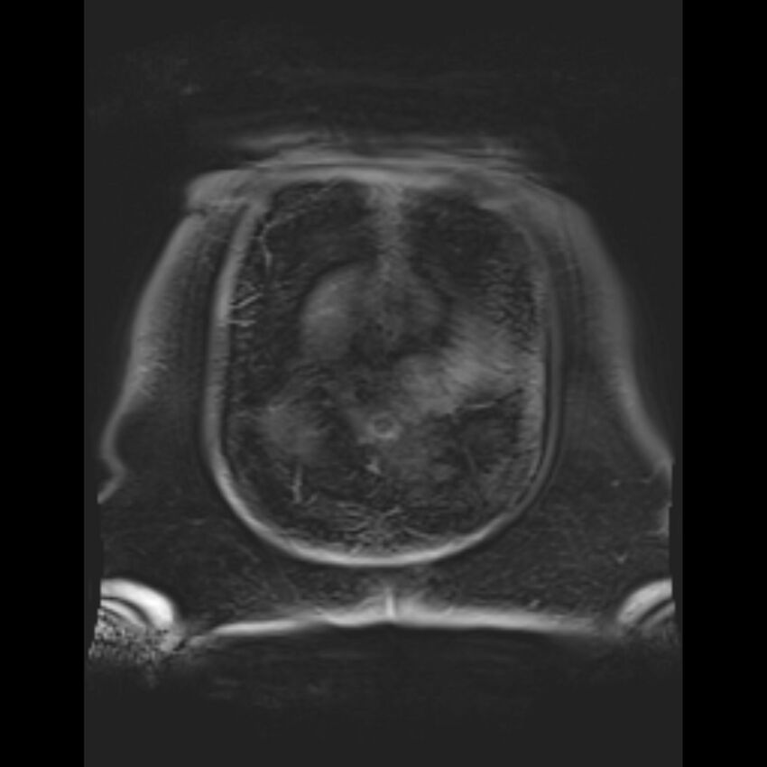 Bilobed placenta accreta (Radiopaedia 69648-79591 Coronal T1 vibe 4).jpg
