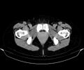 Blind-ending branch of a bifid ureter (Radiopaedia 43613-47034 A 192).jpg