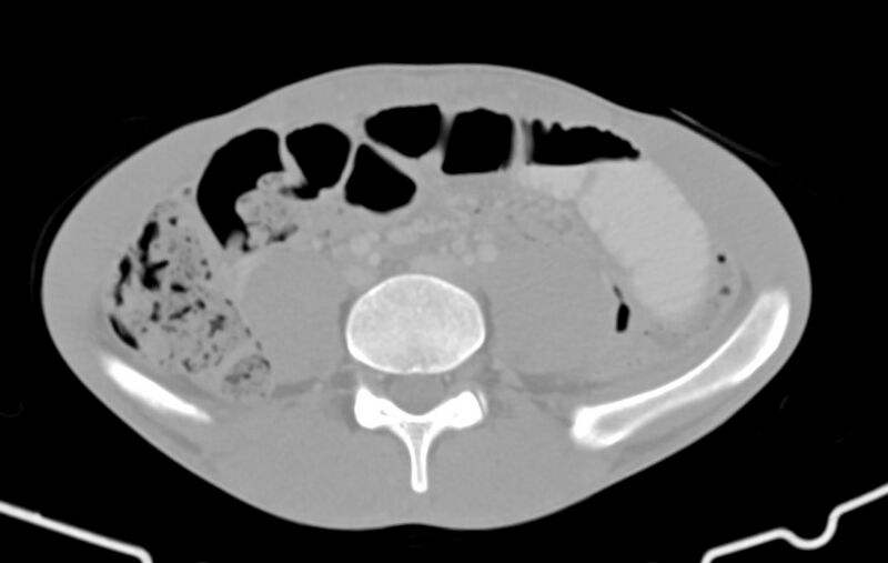 File:Blunt injury to the small bowel (Radiopaedia 74953-85987 Axial Wide 61).jpg