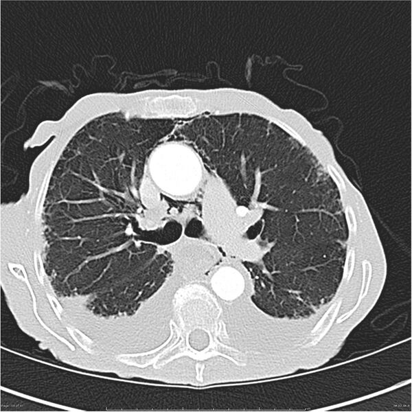 File:Boerhaave syndrome (Radiopaedia 26240-26362 Axial lung window 19).jpg