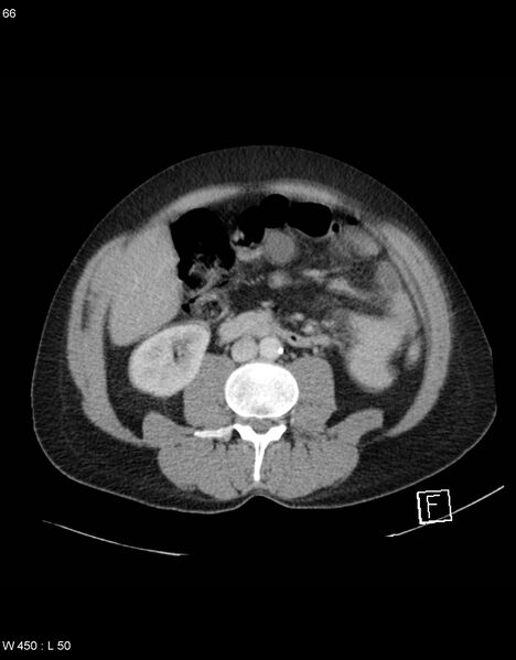 File:Boerhaave syndrome with tension pneumothorax (Radiopaedia 56794-63603 A 33).jpg