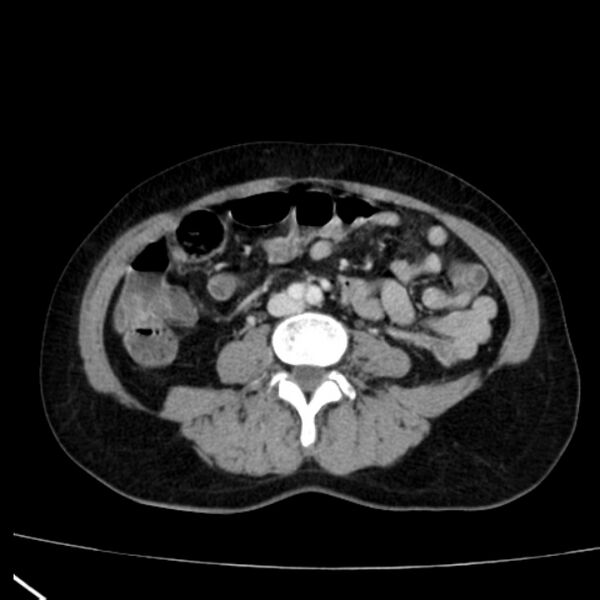 File:Bosniak renal cyst - type I (Radiopaedia 27479-27675 C 55).jpg