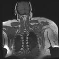 Brachial plexopathy (Radiopaedia 21844-21806 Coronal T1 C+ 17).jpg