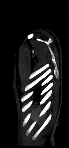 File:Brachiocephalic trunk pseudoaneurysm (Radiopaedia 70978-81191 C 88).jpg