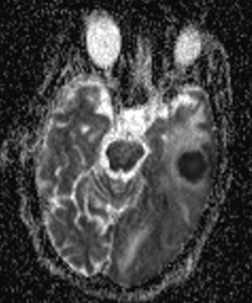 File:Brain abscess with dual rim sign (Radiopaedia 87566-103938 Axial ADC 6).jpg