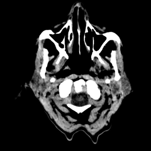 File:Brain metastases from lung cancer (Radiopaedia 27849-28092 Axial non-contrast 1).jpg