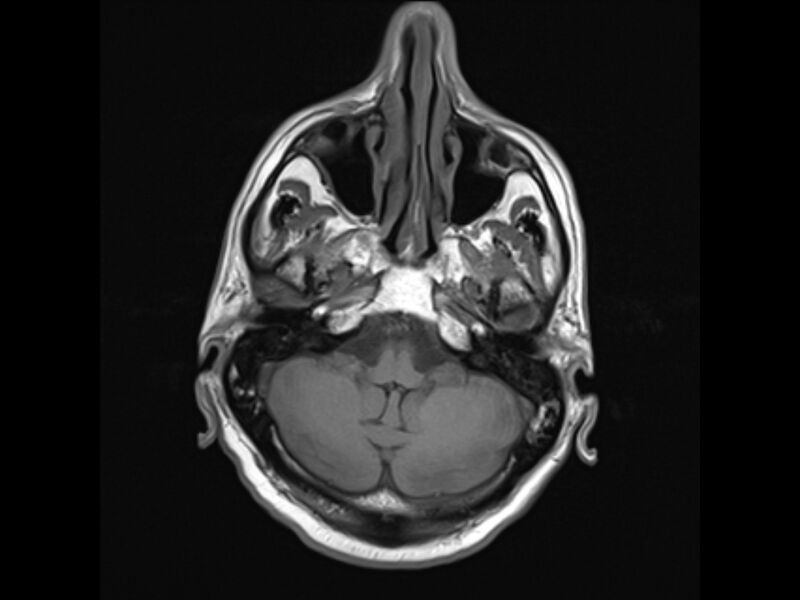 File:Brain metastases from renal cell carcinoma (Radiopaedia 42222-45297 Axial T1 6).jpg