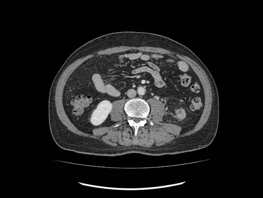Brain metastases from renal cell carcinoma (Radiopaedia 42222-45328 B 157).jpg