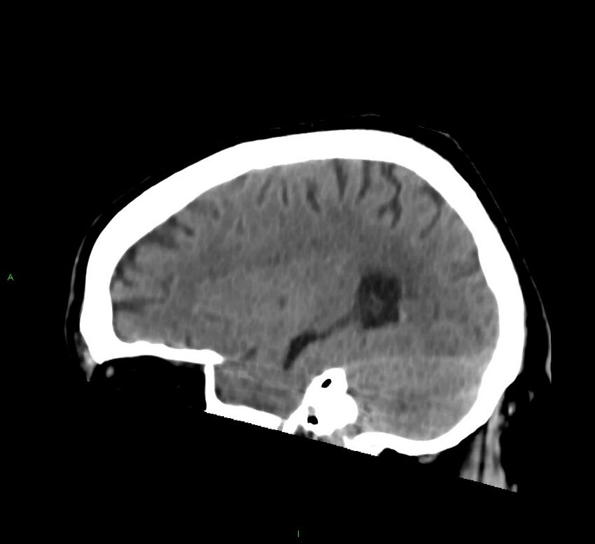 Brainstem hemorrhage (Radiopaedia 58794-66028 C 16).jpg