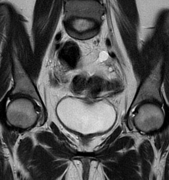 File:Broad ligament leiomyoma (Radiopaedia 81634-95516 Coronal T2 10).jpg