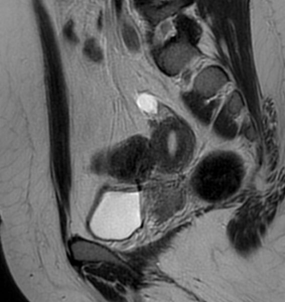 File:Broad ligament leiomyoma (Radiopaedia 81634-95516 Sagittal T2 19).jpg