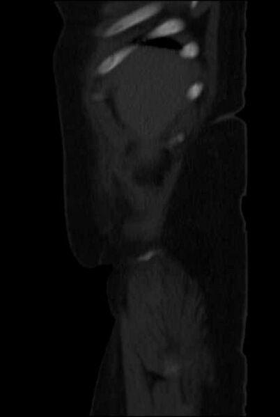File:Brown tumors compressing the spinal cord (Radiopaedia 68442-77988 H 6).jpg