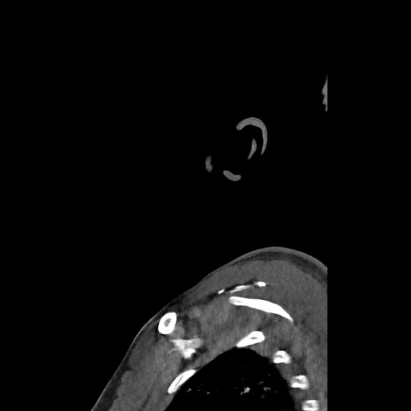 File:Buccal fat pad arteriovenous malformation (Radiopaedia 70936-81144 C 75).jpg