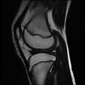 Bucket handle tear - lateral meniscus (Radiopaedia 72124-82634 Sagittal T2 5).jpg