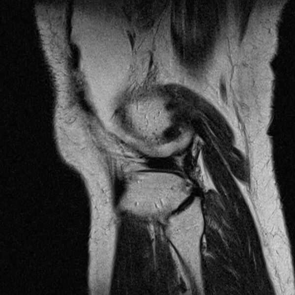 File:Bucket handle tear - medial meniscus (Radiopaedia 79028-91942 Sagittal T2 3).jpg