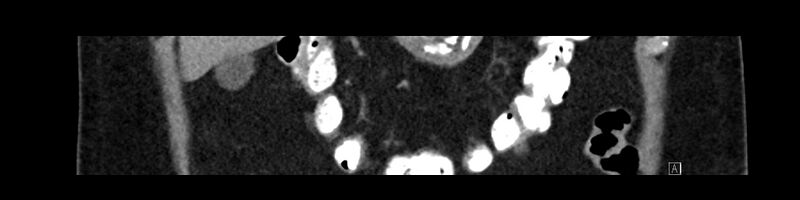 File:Buried bumper syndrome - gastrostomy tube (Radiopaedia 63843-72575 Coronal 33).jpg